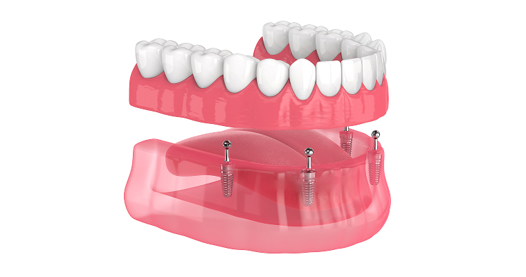 All-On-Four Dental Implants: Are They Really Worth It?