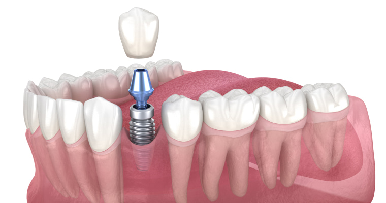 Why No Dairy After Dental Implant? Here’s What You Need to Know
